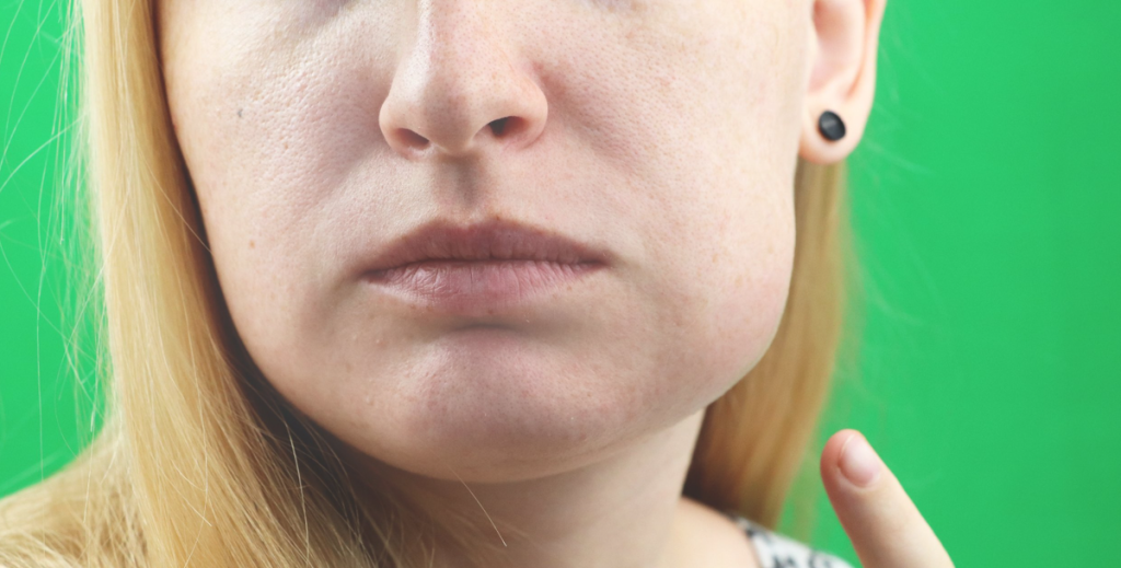 image of Women having swelling in lower jaw after wisdom tooth rmoval. its thee hero image for article (How Long Does Swelling Last After Wisdom Teeth Removal? Your Complete Guide to a Speedy Recovery)