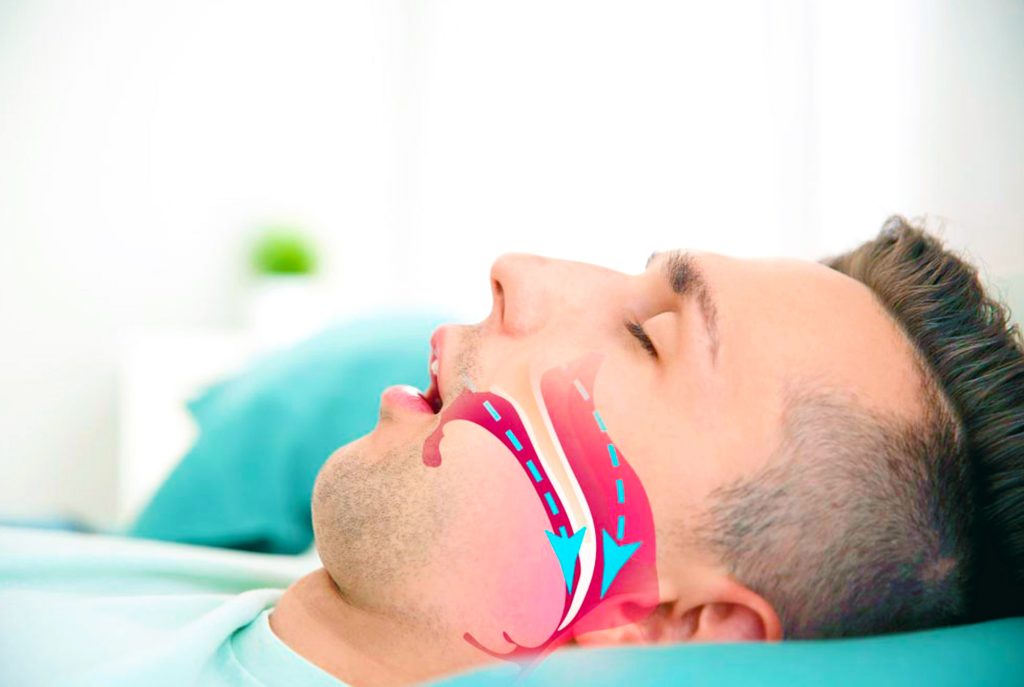 How to Prevent Sleep Apnea with Myofunctional Therapy: A Comprehensive Guide