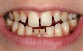 Localized microdontia affecting few tiny teeth in adult. 