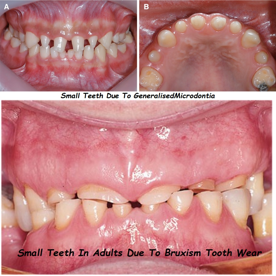 Microdontia related small teeth and Bruxism causing small teeth in adults.