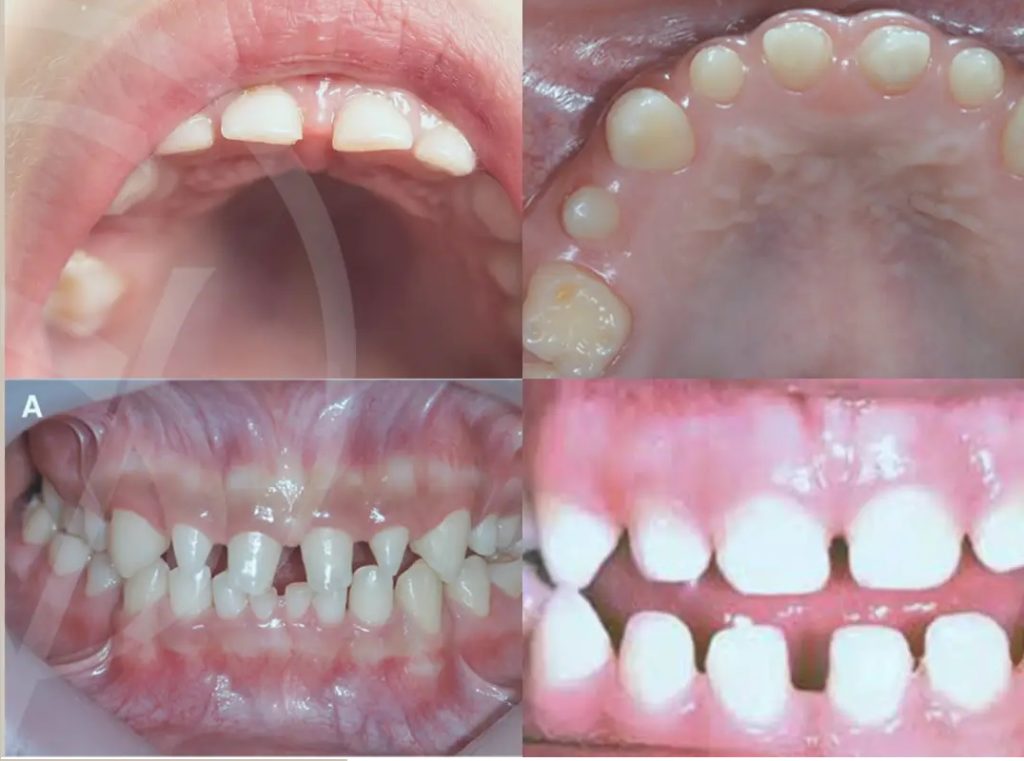 Microdontia related small teeth causing gaps in teeth.