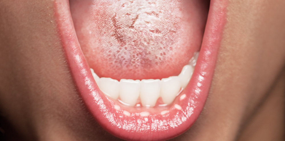 Oral thrush related brown spot on tongue. is brown tongue dangerous.