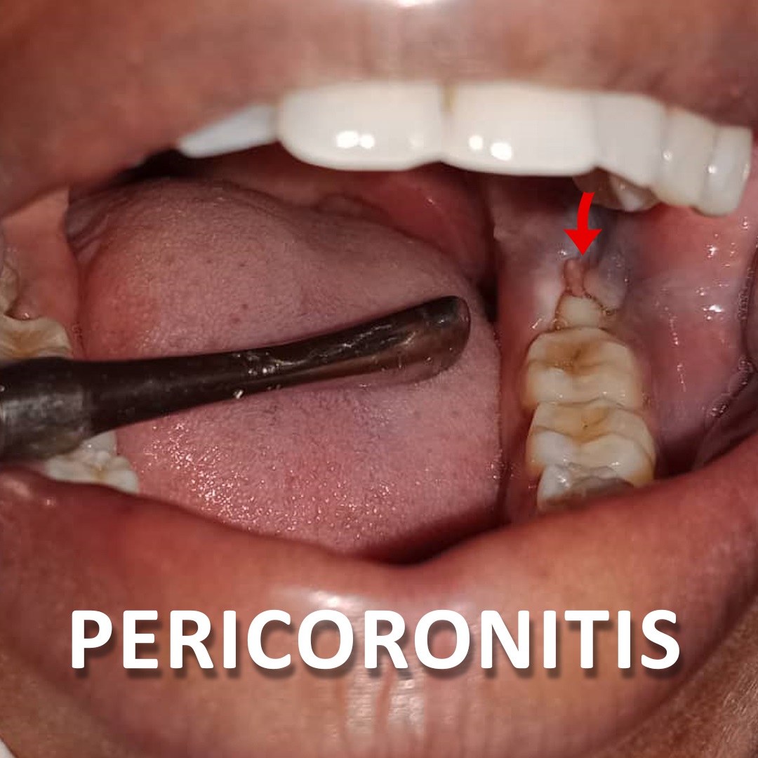 Pericoronitis- Gum infection near growing wisdom tooth causing pain in area around wisdom tooth