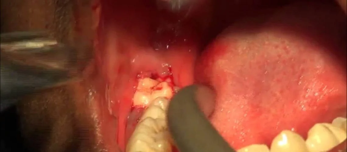 Pericoronitis Opperculitis= Removal of Infected gum around growing wisdom tooth to relieve pain