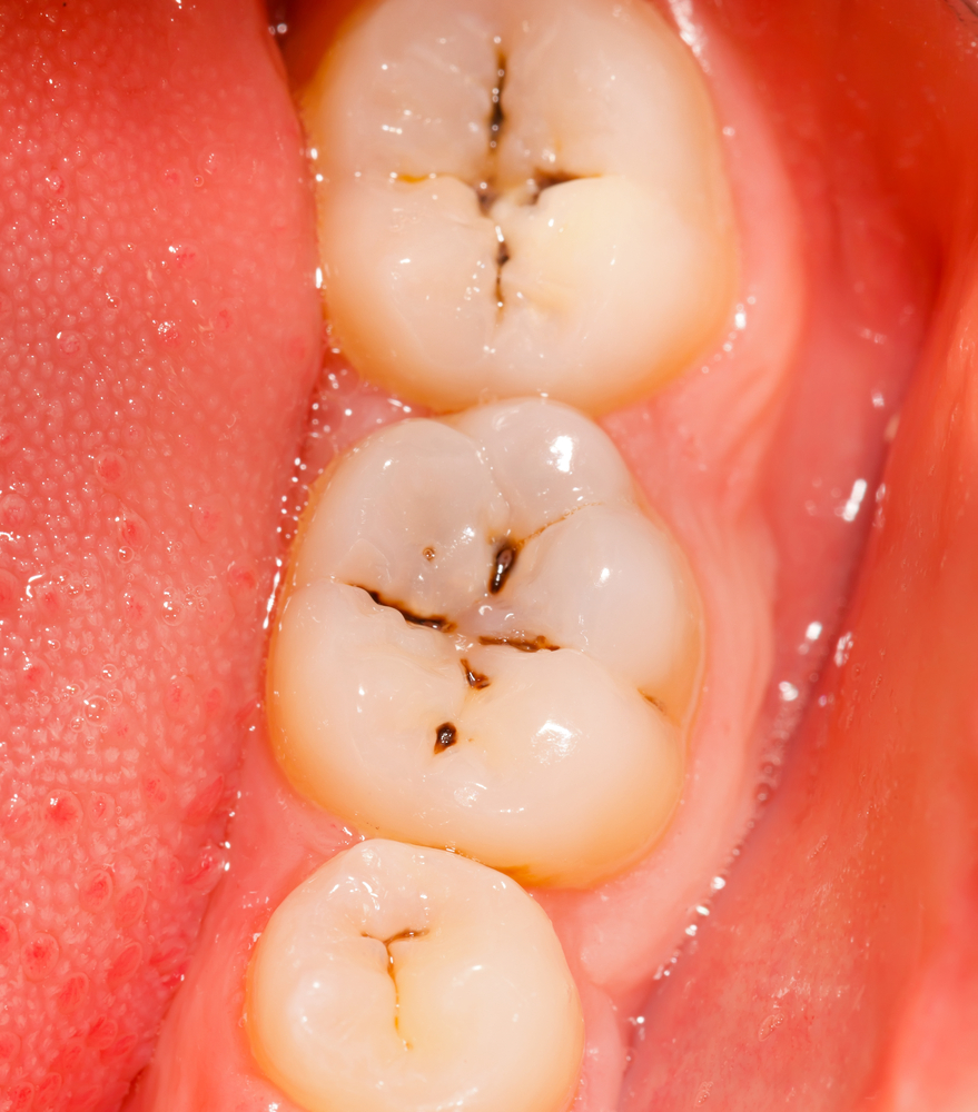 Pit and Fissure Types Of Dental Cavities