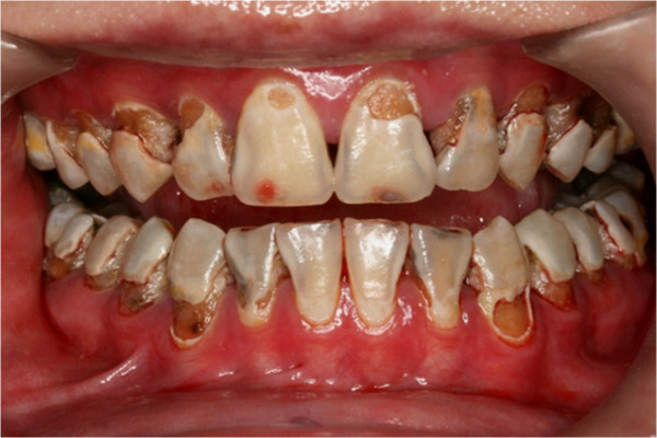 Severe enaml erosion forming cavities responsible for front teeth hurt all of a sudden