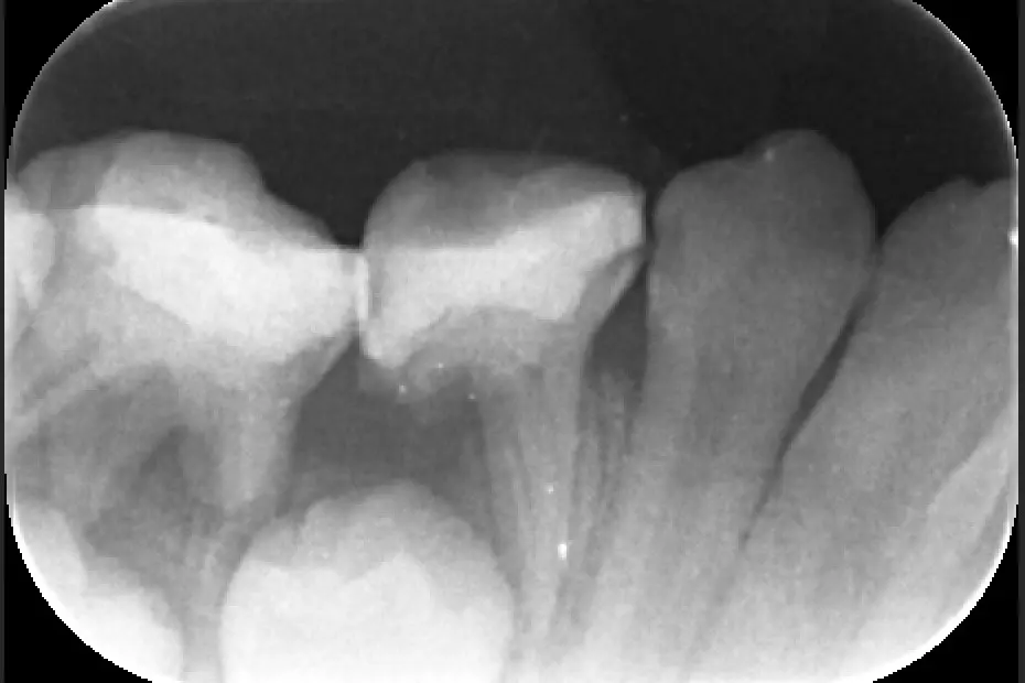 Periapical Xray of toddler teeth