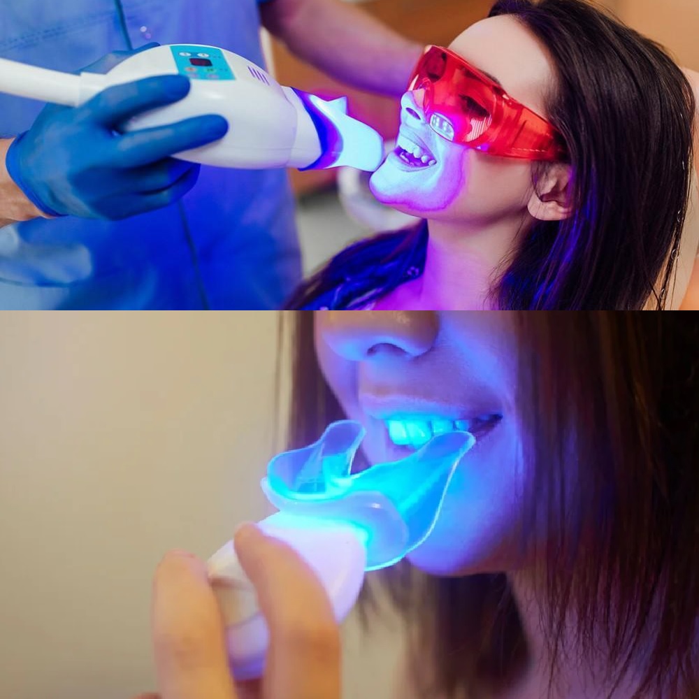 Professional Teeth Whitening vs. At-Home Whitening: Which Is Right for You?