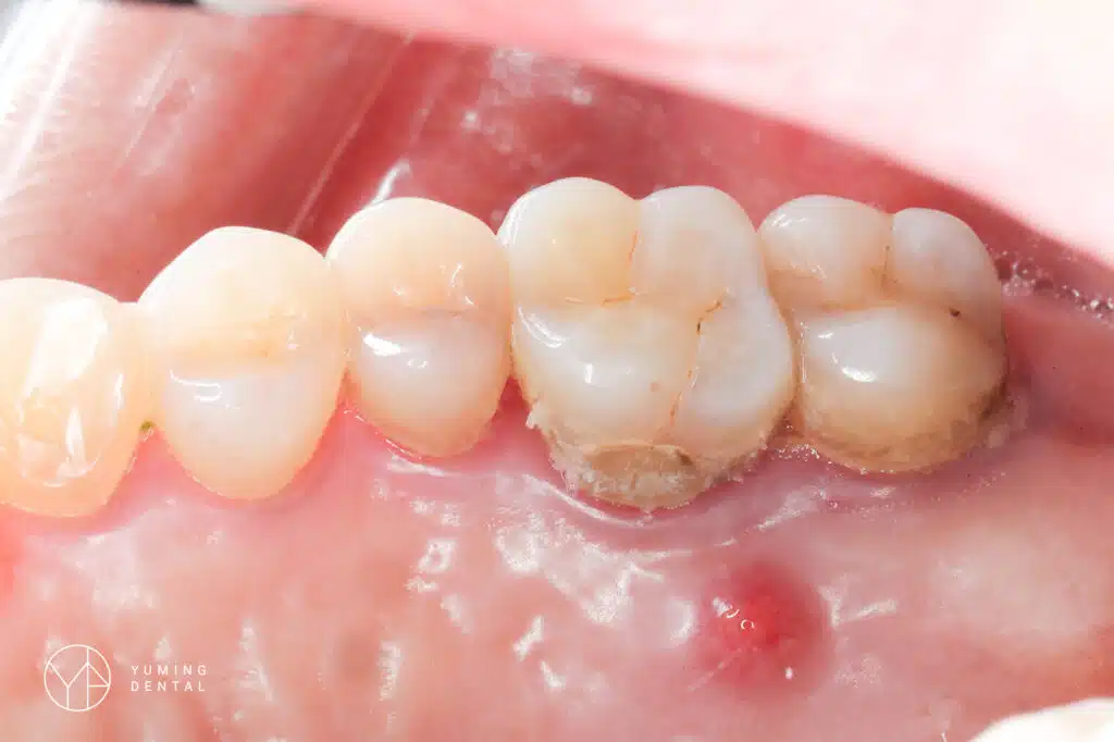 Root Canal Infection (Sinus formation on gums near root canal treated tooth