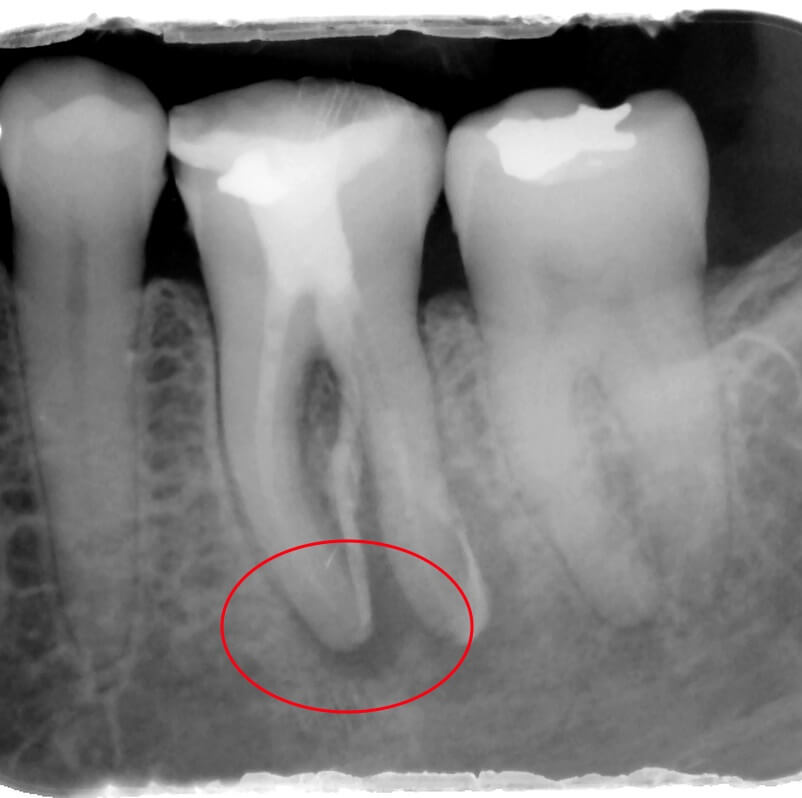 Root Canal Infection Visible As Black Area Around Teeth On Radiograph