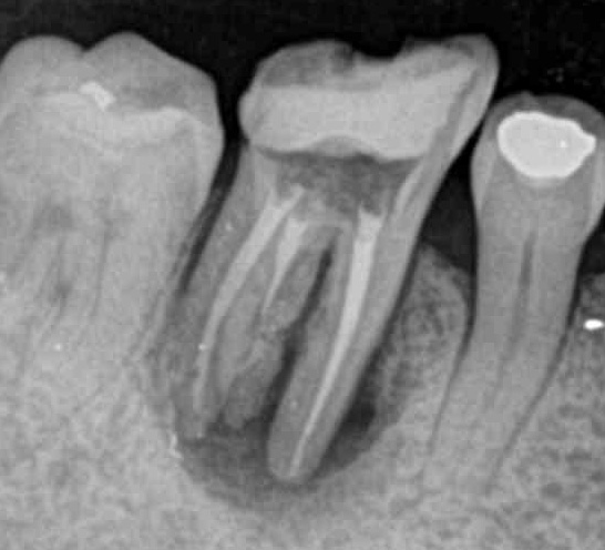 Root Canal Infection in x-ray as black area around tooth roots