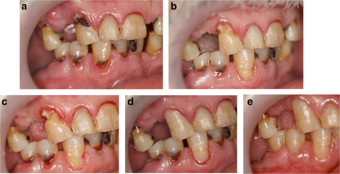 Root Cavities Treatment with Dental Bonding(Dental Composite)