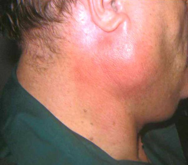 Sialolithiasis (salivary gland stones) Causing Jaw Swelling on On e side.