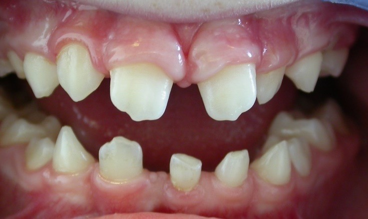 Small teeth due to ectodermal dysplasia