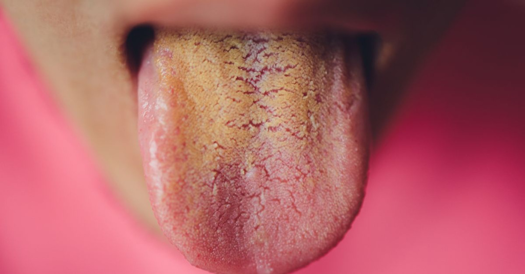 Smoking brown spots on tongue