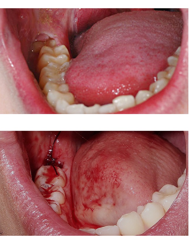 how long does it take for swelling to go down after wisdom teeth removal. Surgical removal of wisdom tooth cause trauma to jaw bon and tissue and can have swelling later on