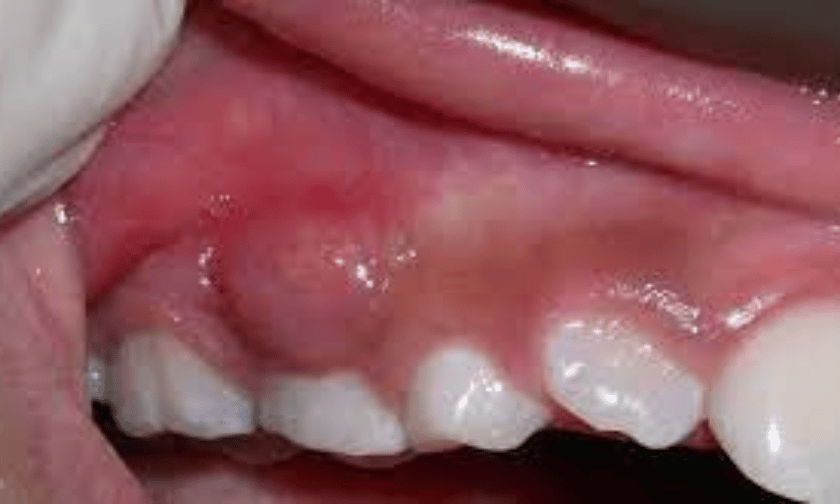 Swollen gum around root canal treated tooth as sign of root canal infection