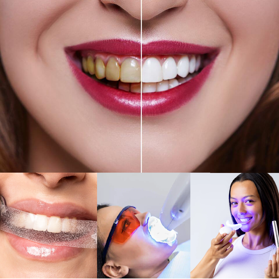 Teeth Whitening Options: Find the Best Solution for a Brighter Smile