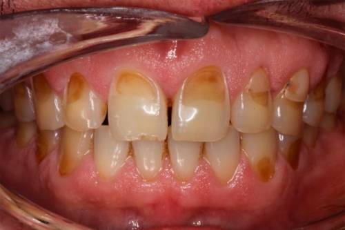 Teeth enamel erosion answer to why do my front teeth hurt all of a sudden or why do all of my teeth hurt?