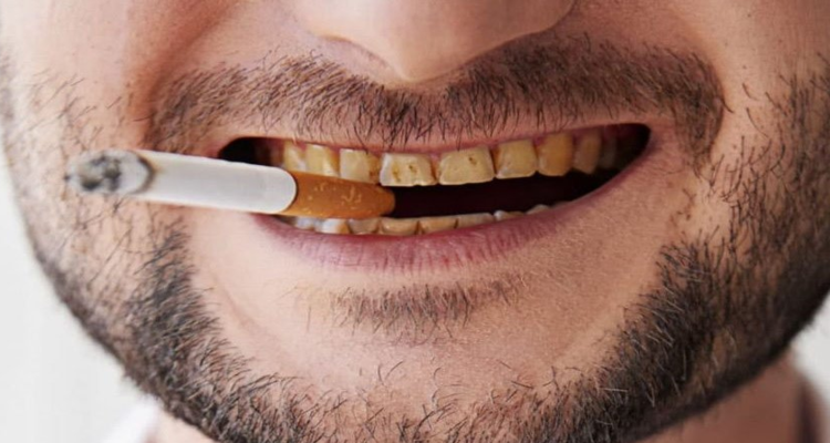 The Effects of Smoking on Oral Health: Risks, Symptoms, and Prevention