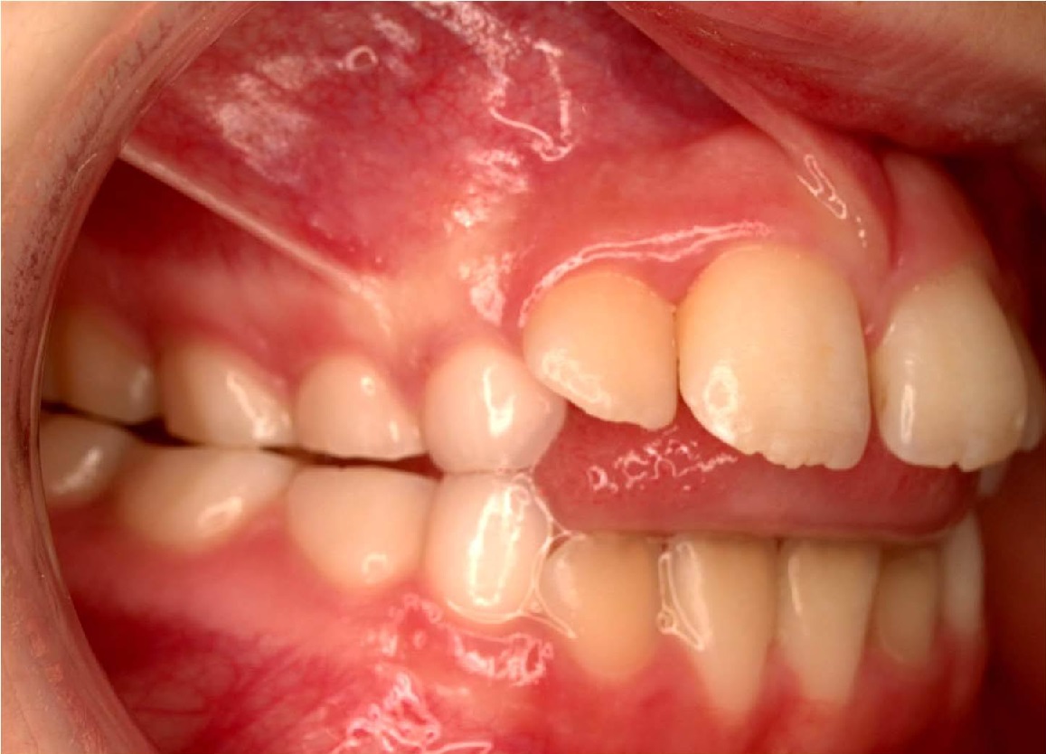 TongueThrust in OMDs(Orofaical myofuntional disorders)-Tongue Thrusting Pushing the tongue against or between the teeth when swallowing or speaking.