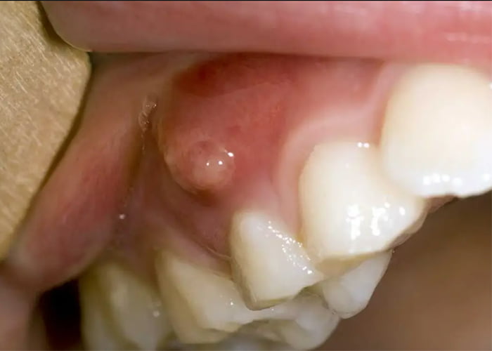 Tooth Abscess as sign of root canal infection.