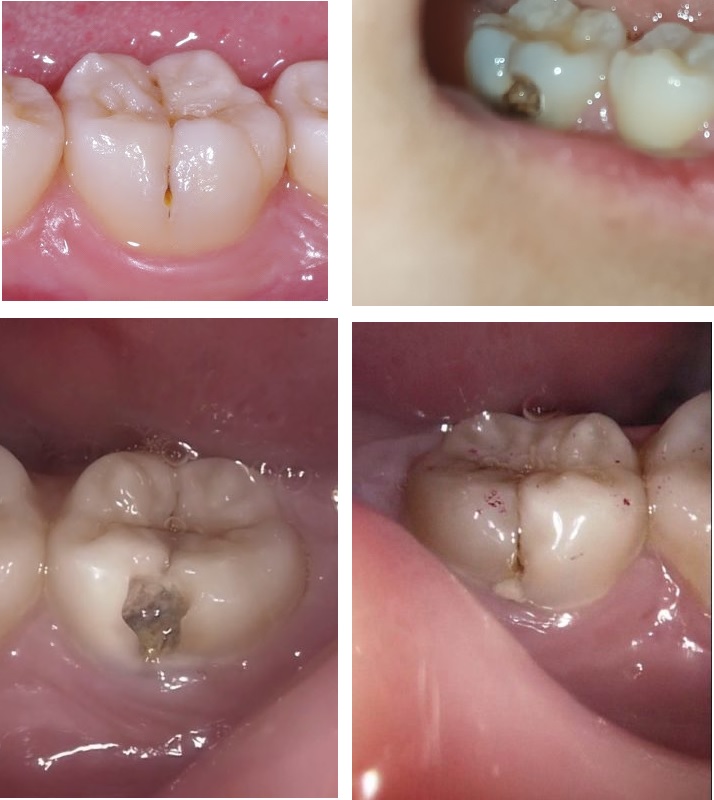 Tooth Buccal Pit Cavities: Causes, Treatment, and Prevention of Buccal Pit Decay