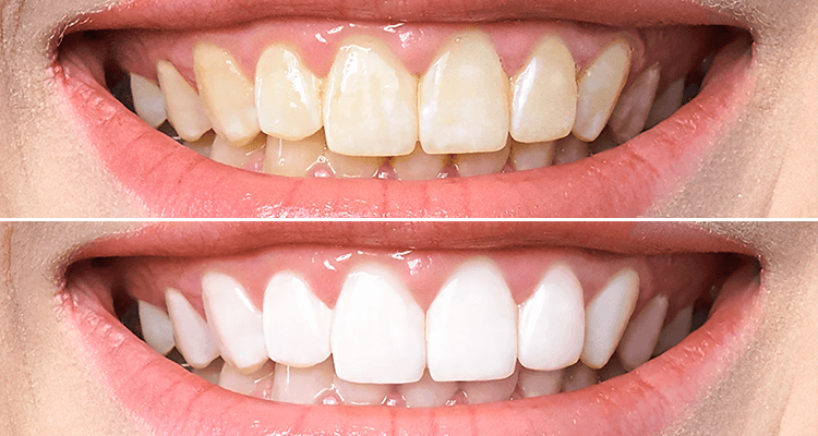 Ultimate Guide to Whitening Teeth: Proven Tips for How to Get White Teeth Naturally at Home Fast