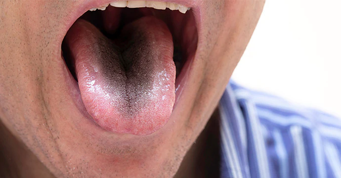 Understanding Black Hairy Tongue: Causes, Symptoms, and Treatment