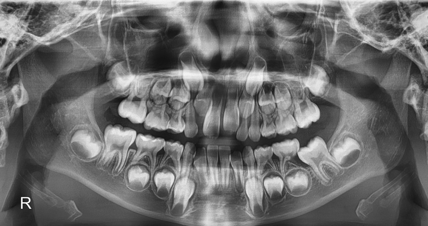 Xray of baby teeth toddler teeth xray