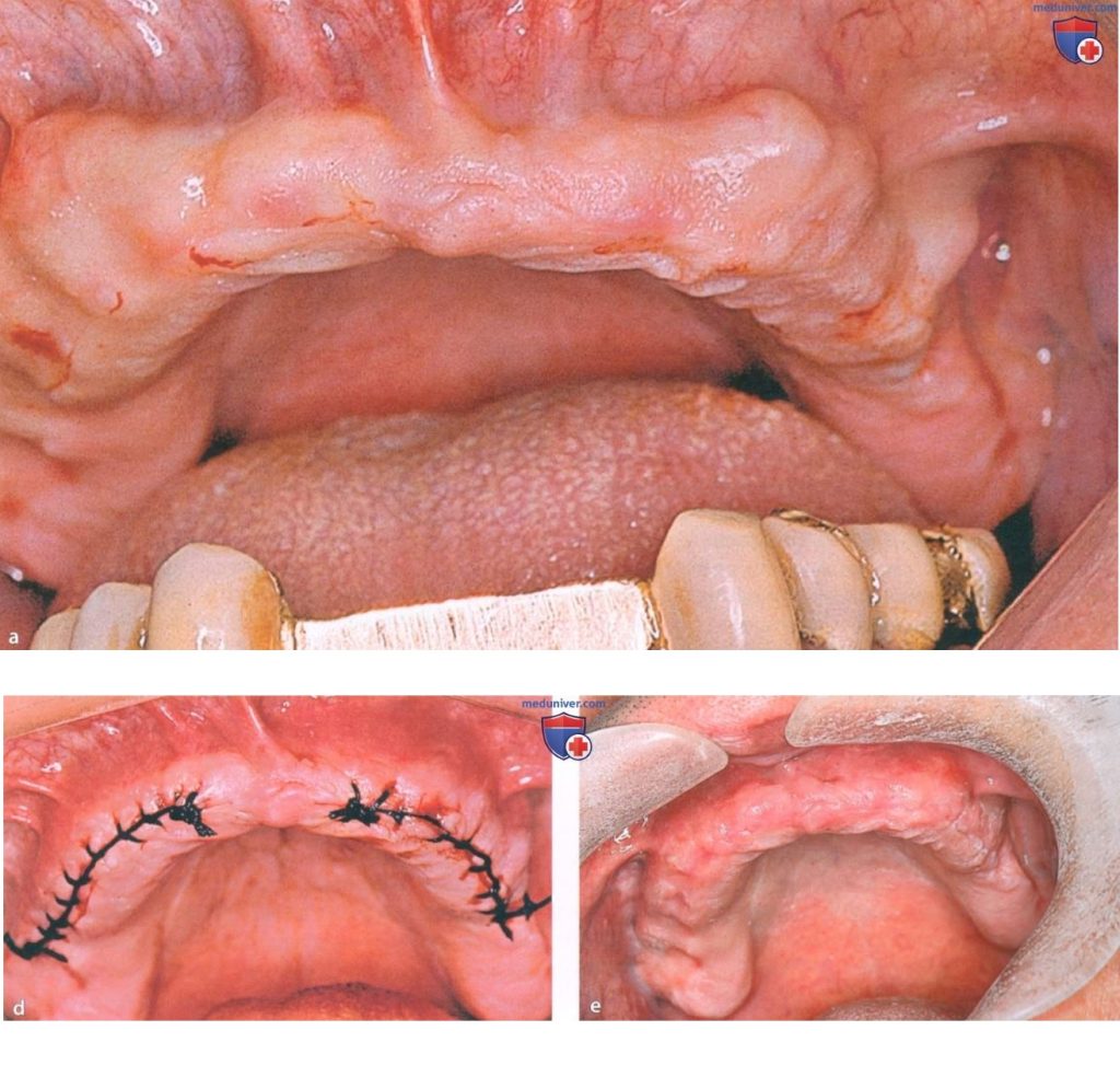 Alveoloplasty procedure to prepare Jaw for denture placement