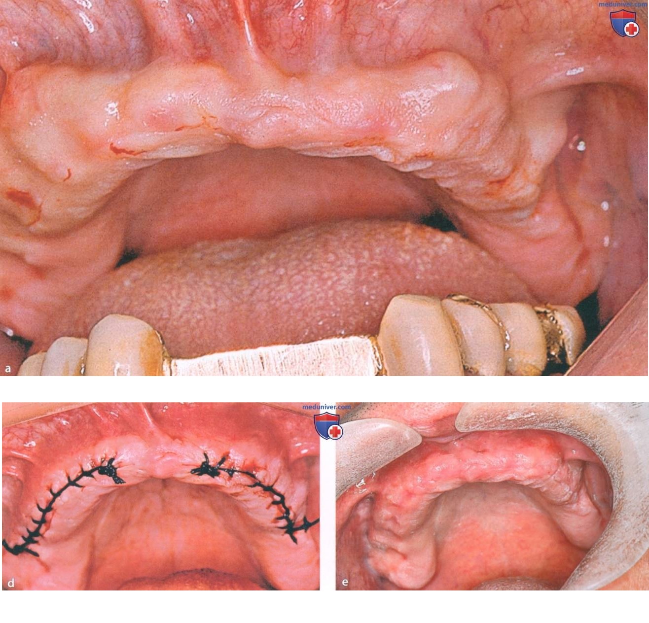 Alveoloplasty: The Complete Guide to Smoothing Your Jawbone for Better Dentures and Tooth Extractions