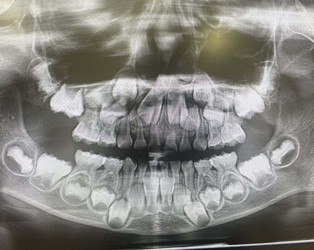 baby teeth xray- child baby teeth xray-OPG Xray showing coming permanent teeth and milky teeth