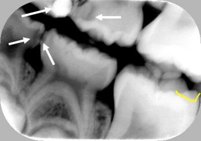 bitewing  xray of baby teeth.