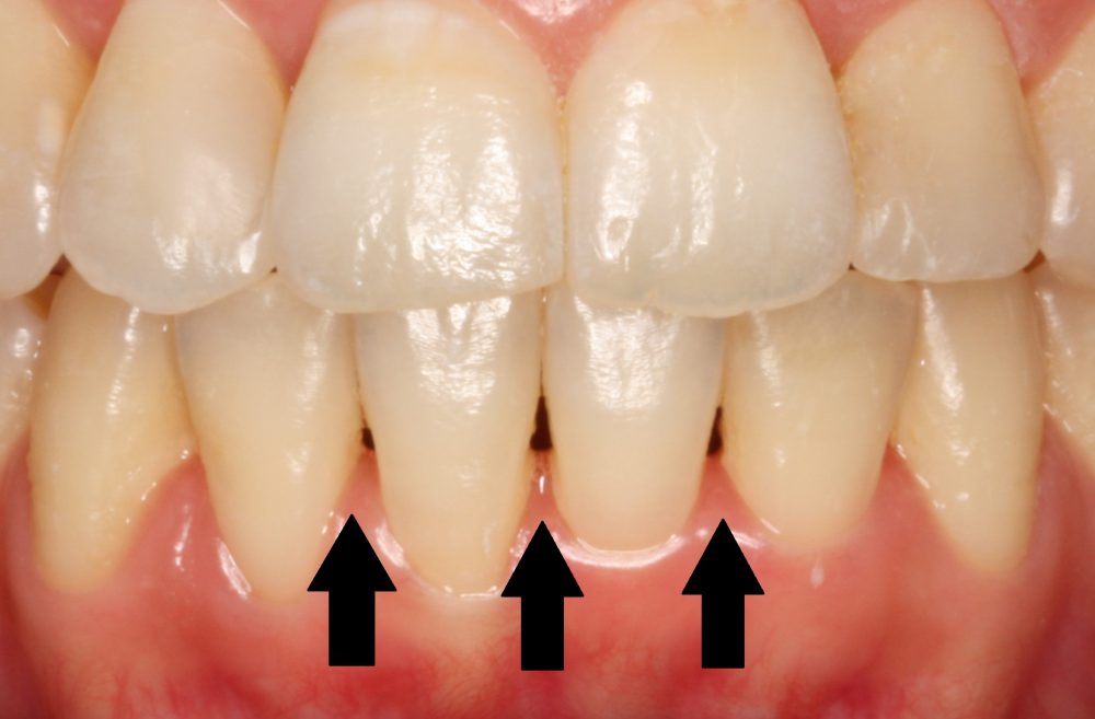 Black in between teeth also called Black Triangle Teeth.