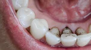 Black stains on back of teeth due to coffee