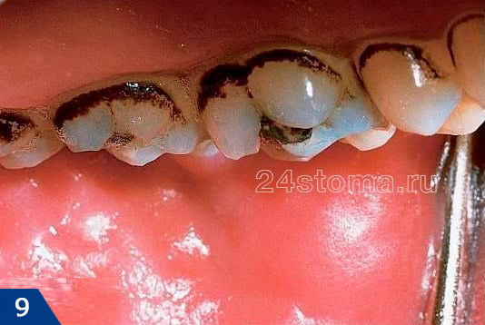 Black stains on back of teeth due to iron supplements use