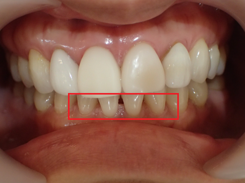 how to get rid of black between teeth. black triangle teeth cosmetic concern to many