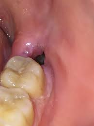 dry socket wisdom teeth.. how long is dry socket a risk