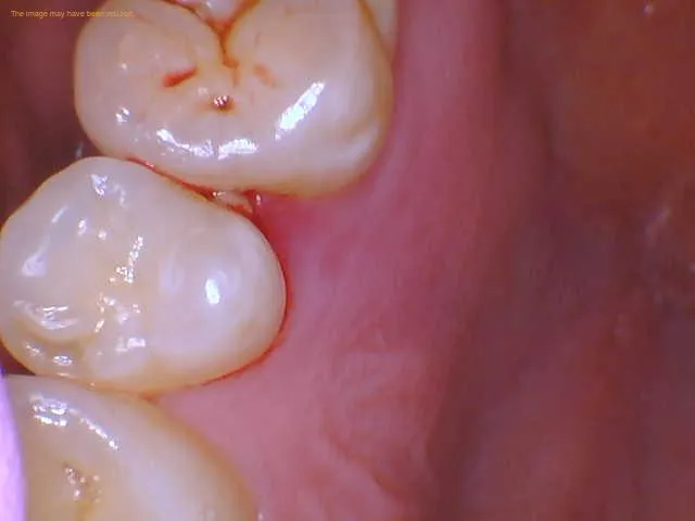 food stuck in gums-something stuck in gums floss not working