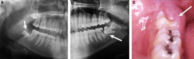 growing wisdom tooth . Wisdom Tooth Growing Pain: How Long It Lasts and Effective Relief Tips