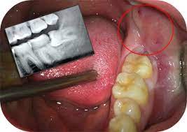 when will the swelling go down from wisdom teeth. Impacted wisdom tooth extraction need removal of overlying bone and swelling in jaw after surgery. 