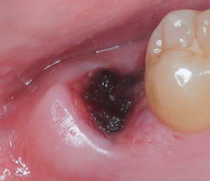 when is the risk of dry socket over, Normal socket after wisdom tooth removal