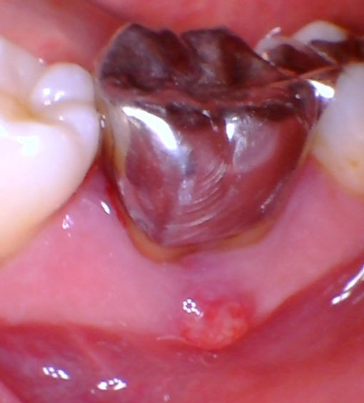 pimple on gum around root canal treated tooth