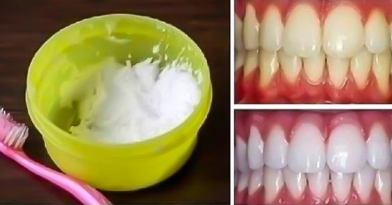 teeth whitening at home in 2 minutes with baking soda