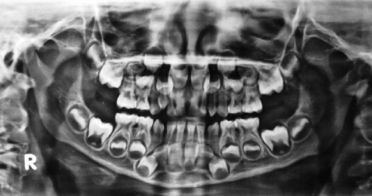 x-ray of baby teeth and permanent teeth -Orthopantomogram-showing-bilateral-distribution-of-maxillary-supernumerary-canines infants