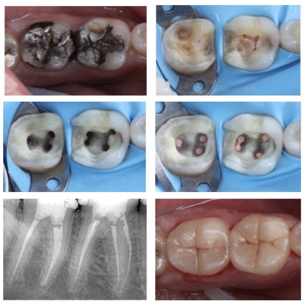 Root Canal: Everything You Need to Know